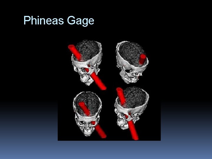 Phineas Gage 