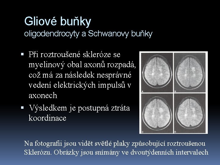 Gliové buňky oligodendrocyty a Schwanovy buňky Při roztroušené skleróze se myelinový obal axonů rozpadá,