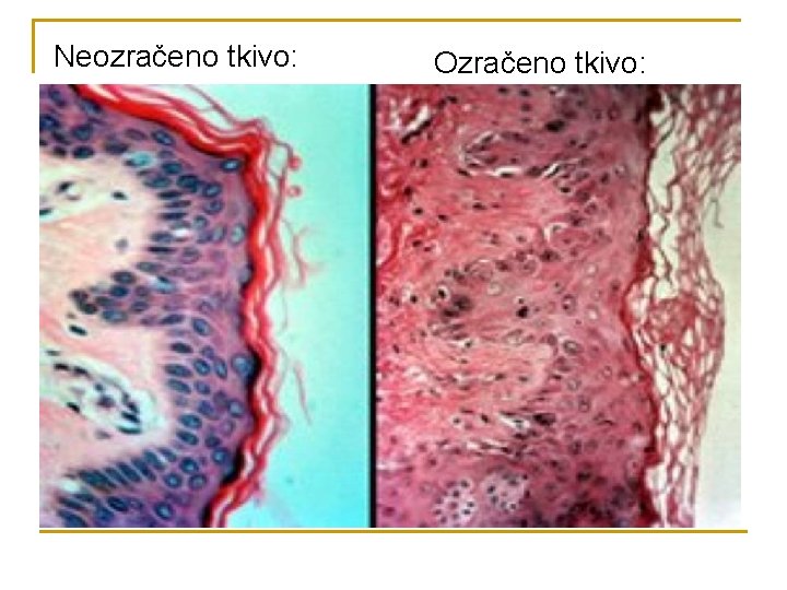 Neozračeno tkivo: Ozračeno tkivo: 