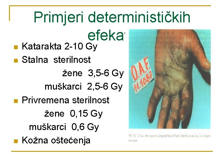 Primjeri determinističkih efekata n n Katarakta 2 -10 Gy Stalna sterilnost žene 3, 5 Primjeri determinističkih efekata n n Katarakta 2 -10 Gy Stalna sterilnost žene 3, 5