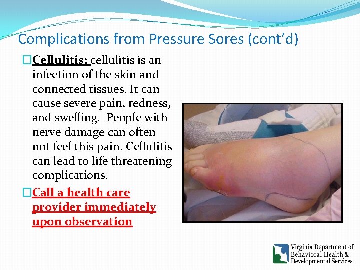 Complications from Pressure Sores (cont’d) �Cellulitis: cellulitis is an infection of the skin and