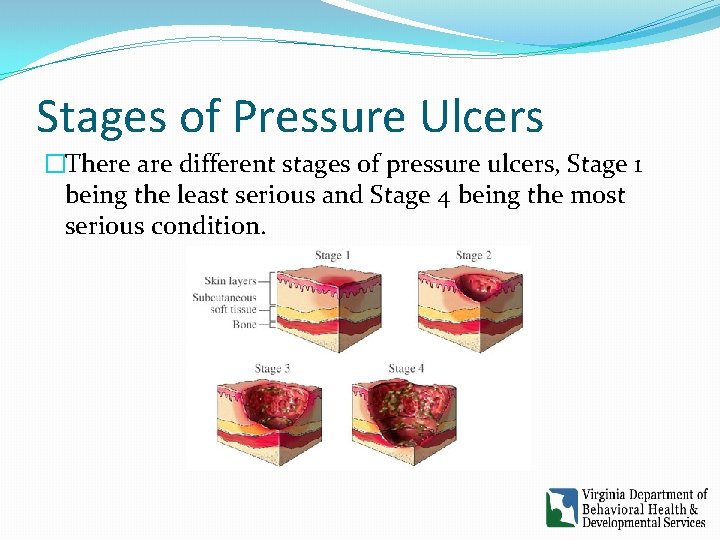 Stages of Pressure Ulcers �There are different stages of pressure ulcers, Stage 1 being