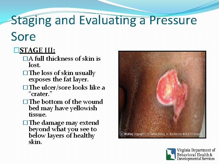 Staging and Evaluating a Pressure Sore �STAGE III: �A full thickness of skin is