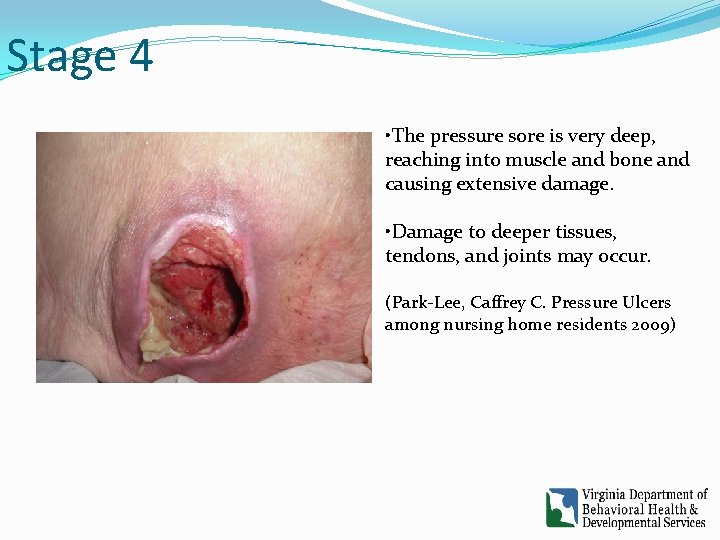 Stage 4 • The pressure sore is very deep, reaching into muscle and bone
