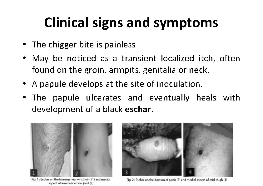 Clinical signs and symptoms • The chigger bite is painless • May be noticed