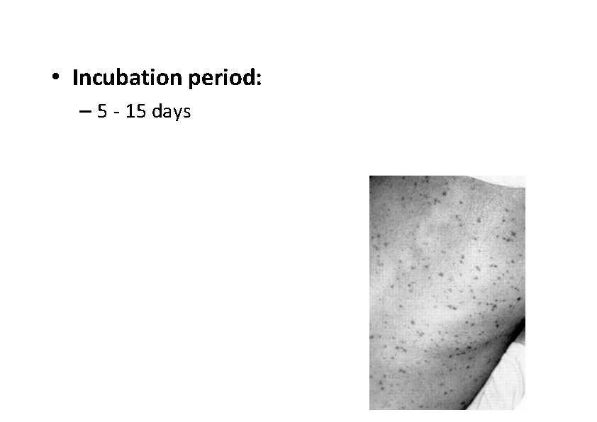  • Incubation period: – 5 ‐ 15 days 