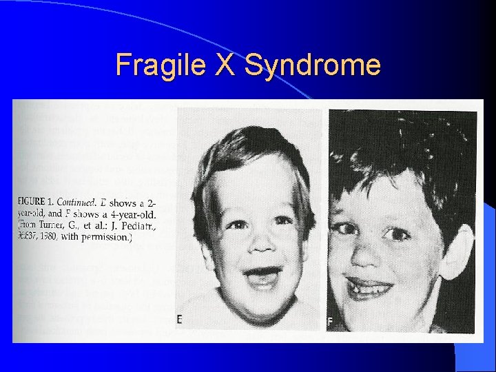 Fragile X Syndrome 