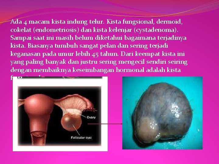 Ada 4 macam kista indung telur. Kista fungsional, dermoid, cokelat (endometriosis) dan kista kelenjar