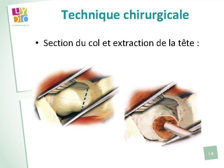 Technique chirurgicale • Section du col et extraction de la tête : 10 