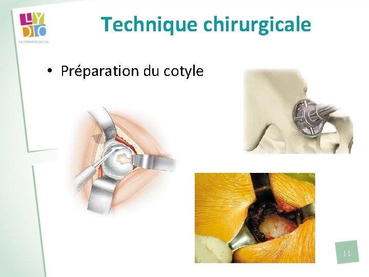 Technique chirurgicale • Préparation du cotyle 11 