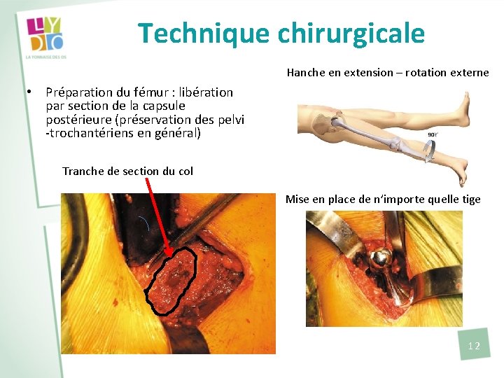 Technique chirurgicale Hanche en extension – rotation externe • Préparation du fémur : libération