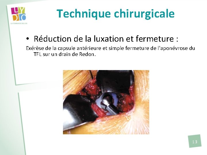 Technique chirurgicale • Réduction de la luxation et fermeture : Exérèse de la capsule