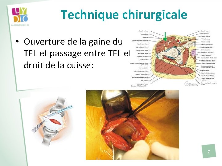 Technique chirurgicale • Ouverture de la gaine du TFL et passage entre TFL et