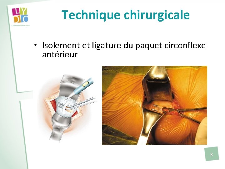 Technique chirurgicale • Isolement et ligature du paquet circonflexe antérieur 8 