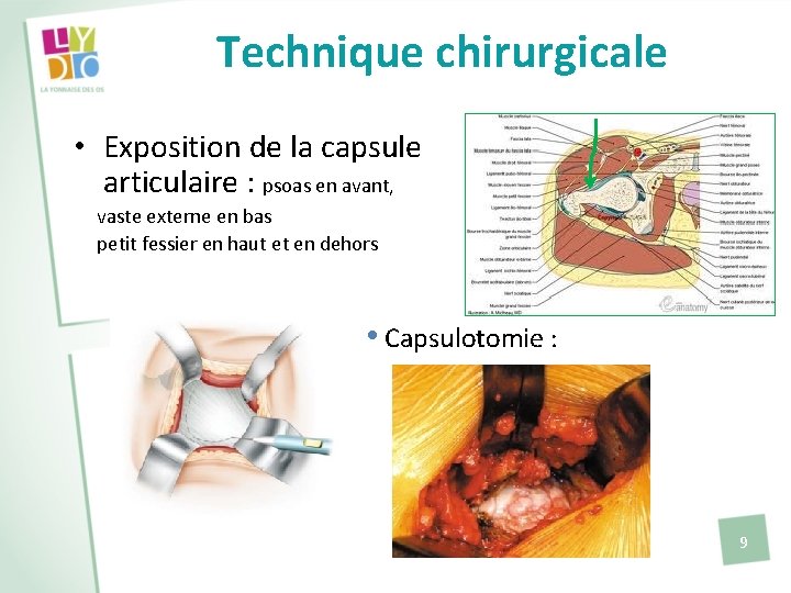 Technique chirurgicale • Exposition de la capsule articulaire : psoas en avant, vaste externe