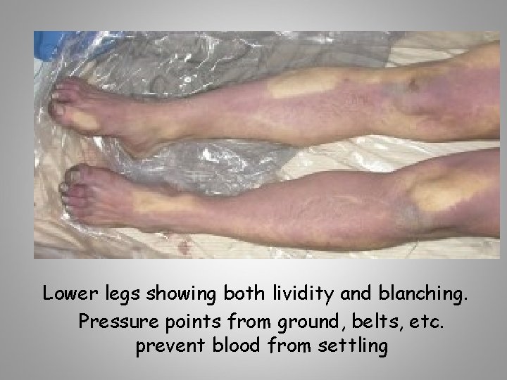 Lower legs showing both lividity and blanching. Pressure points from ground, belts, etc. prevent