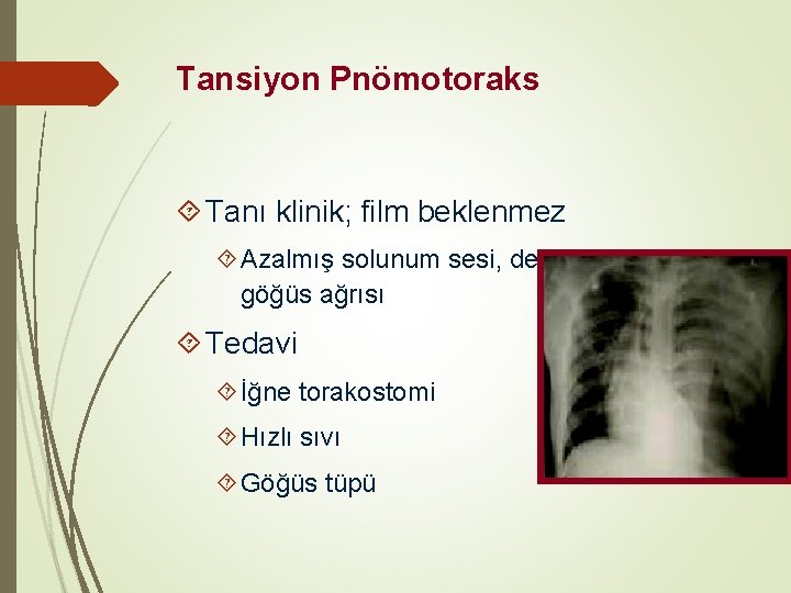 Tansiyon Pnömotoraks Tanı klinik; film beklenmez Azalmış solunum sesi, deviye trakea, göğüs ağrısı Tedavi