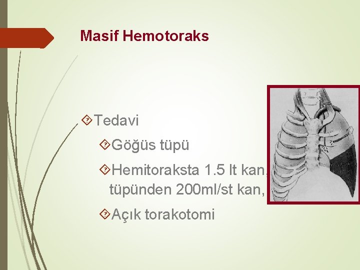 Masif Hemotoraks Tedavi Göğüs tüpü Hemitoraksta 1. 5 lt kan, Göğüs tüpünden 200 ml/st