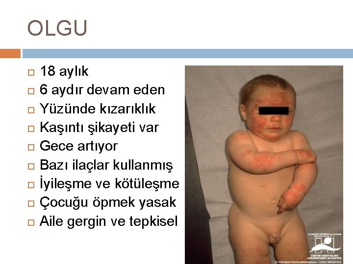 OLGU 18 aylık 6 aydır devam eden Yüzünde kızarıklık Kaşıntı şikayeti var Gece artıyor