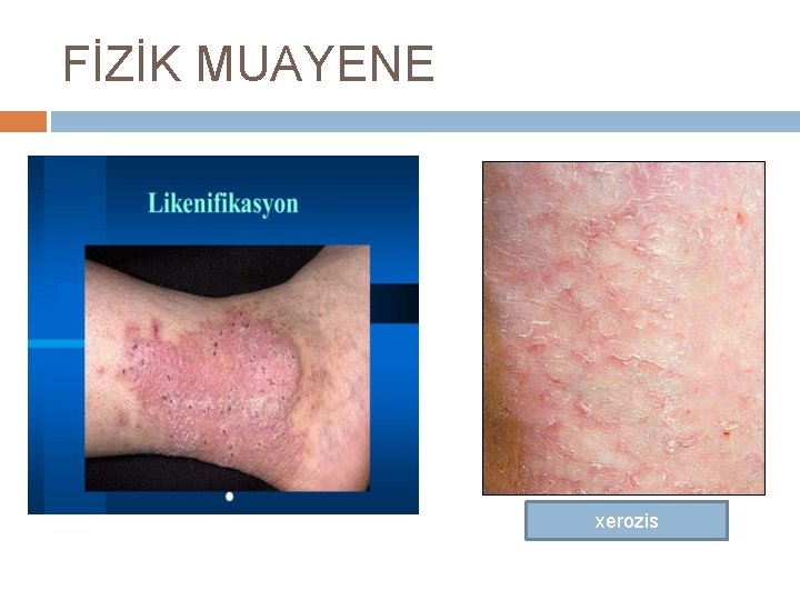 FİZİK MUAYENE xerozis 