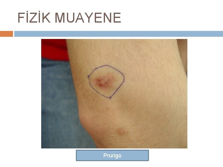 FİZİK MUAYENE Prurigo 