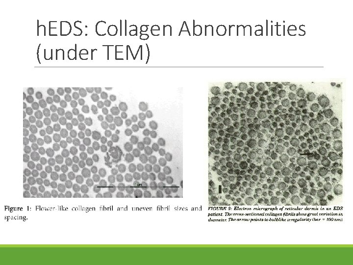h. EDS: Collagen Abnormalities (under TEM) 