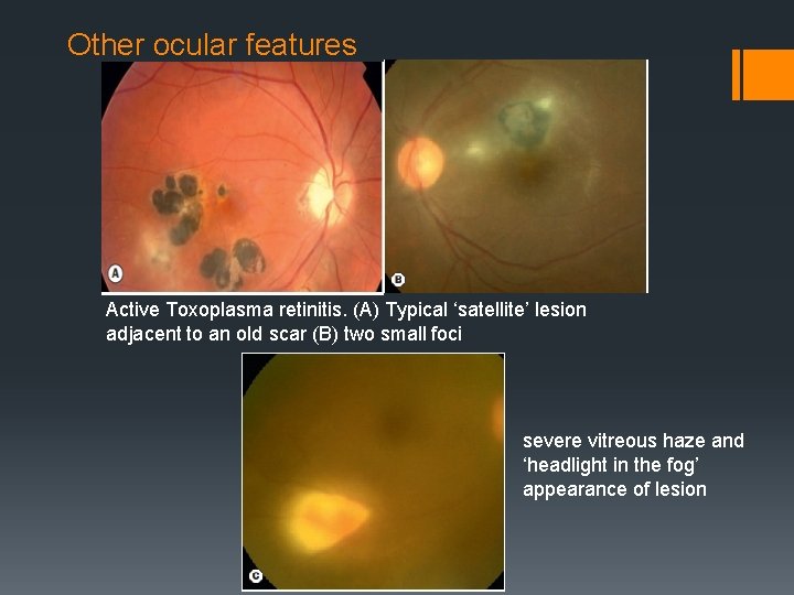 Other ocular features Active Toxoplasma retinitis. (A) Typical ‘satellite’ lesion adjacent to an old