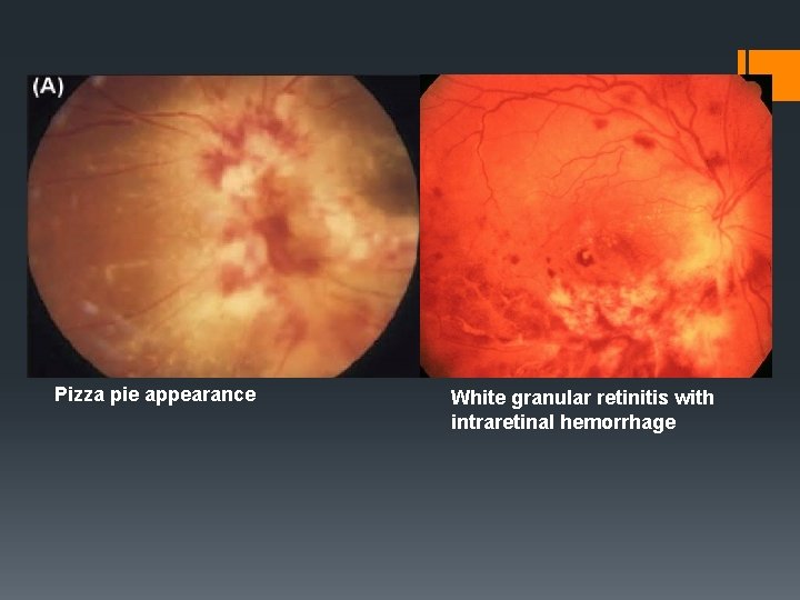 Pizza pie appearance White granular retinitis with intraretinal hemorrhage 