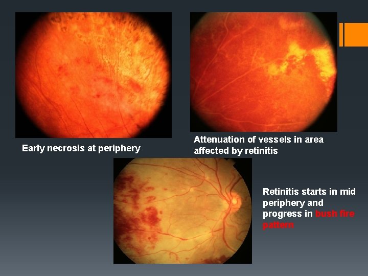 Early necrosis at periphery Attenuation of vessels in area affected by retinitis Retinitis starts