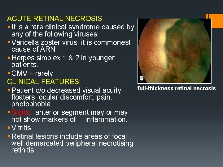 ACUTE RETINAL NECROSIS § It is a rare clinical syndrome caused by any of