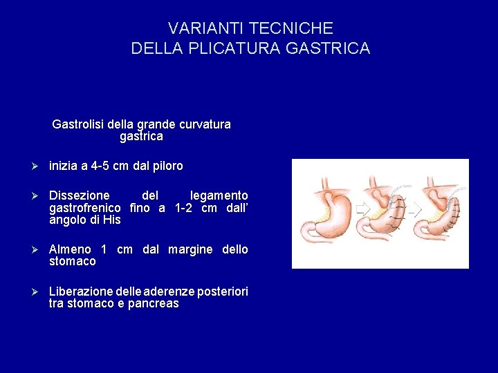 VARIANTI TECNICHE DELLA PLICATURA GASTRICA Gastrolisi della grande curvatura gastrica Ø inizia a 4