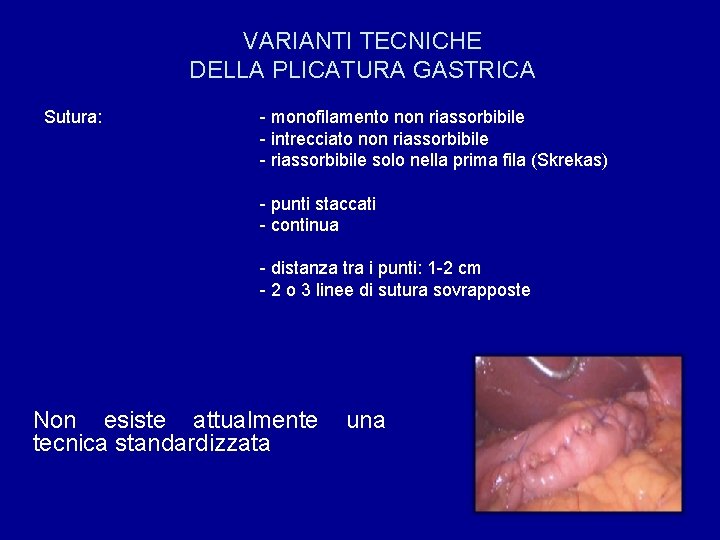 VARIANTI TECNICHE DELLA PLICATURA GASTRICA Sutura: - monofilamento non riassorbibile - intrecciato non riassorbibile