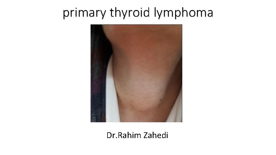 primary thyroid lymphoma Dr. Rahim Zahedi 