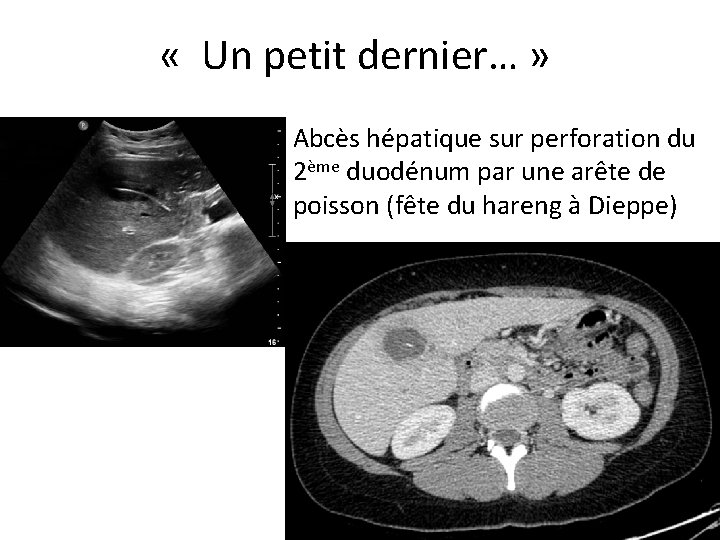  « Un petit dernier… » Abcès hépatique sur perforation du 2ème duodénum par