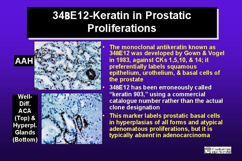 34 BE 12 -Keratin in Prostatic Proliferations AAH Well. Diff. ACA (Top) & Hyperpl.