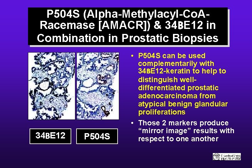 P 504 S (Alpha-Methylacyl-Co. ARacemase [AMACR]) & 34 BE 12 in Combination in Prostatic