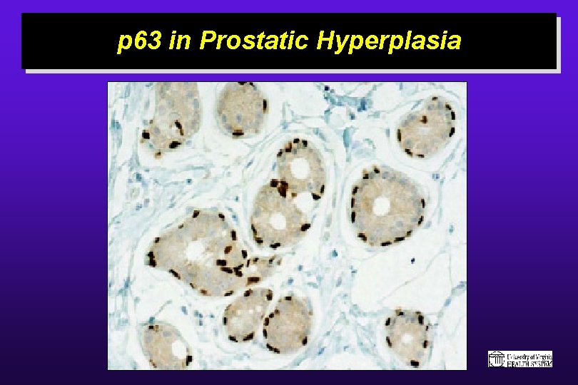 p 63 in Prostatic Hyperplasia 