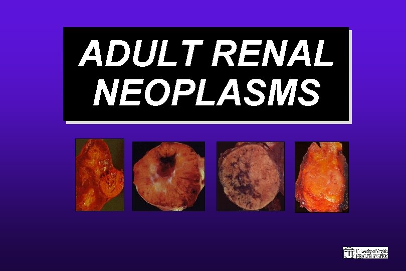 ADULT RENAL NEOPLASMS 