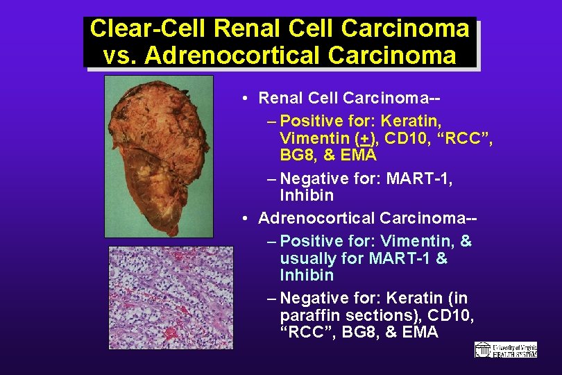 Clear-Cell Renal Cell Carcinoma vs. Adrenocortical Carcinoma • Renal Cell Carcinoma-– Positive for: Keratin,