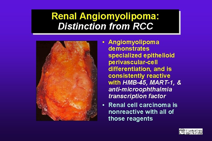 Renal Angiomyolipoma: Distinction from RCC • Angiomyolipoma demonstrates specialized epithelioid perivascular-cell differentiation, and is