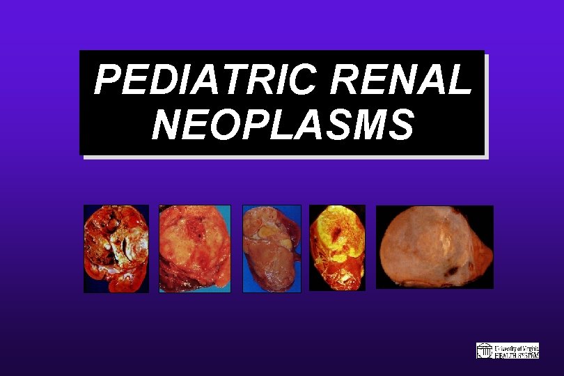PEDIATRIC RENAL NEOPLASMS 