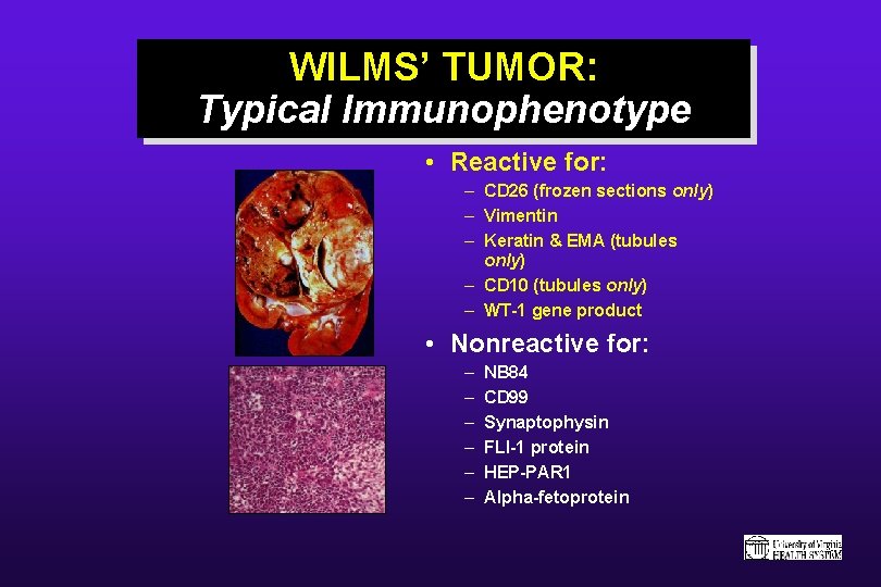 WILMS’ TUMOR: Typical Immunophenotype • Reactive for: – CD 26 (frozen sections only) –