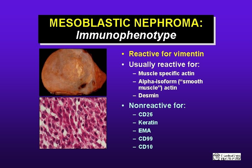 MESOBLASTIC NEPHROMA: Immunophenotype • Reactive for vimentin • Usually reactive for: – Muscle specific