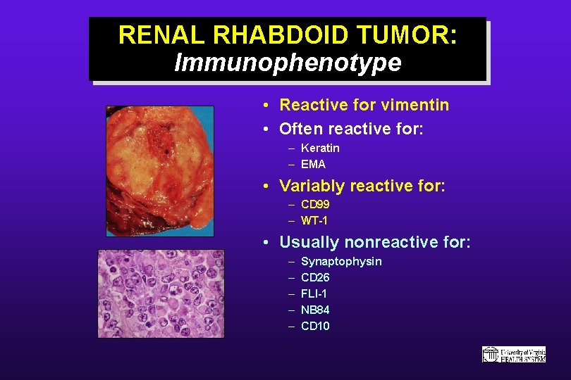 RENAL RHABDOID TUMOR: Immunophenotype • Reactive for vimentin • Often reactive for: – Keratin