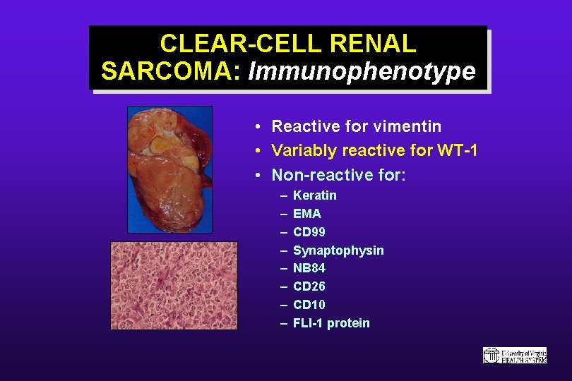 CLEAR-CELL RENAL SARCOMA: Immunophenotype • Reactive for vimentin • Variably reactive for WT-1 •