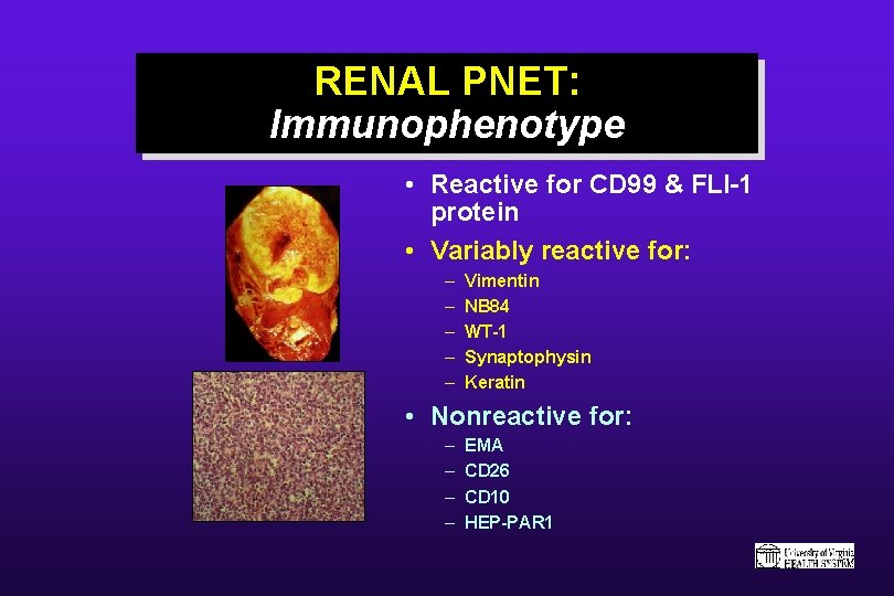 RENAL PNET: Immunophenotype • Reactive for CD 99 & FLI-1 protein • Variably reactive