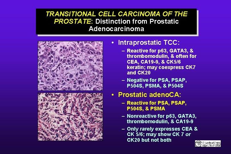 TRANSITIONAL CELL CARCINOMA OF THE PROSTATE: Distinction from Prostatic Adenocarcinoma • Intraprostatic TCC: –