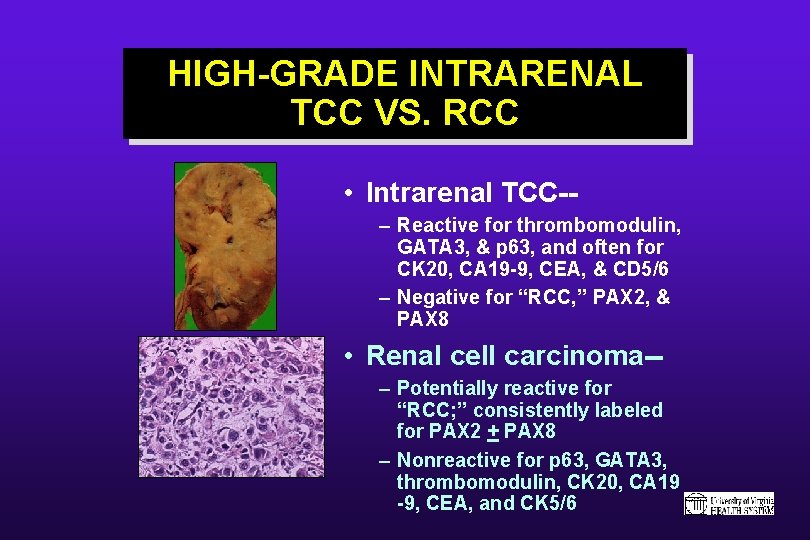 HIGH-GRADE INTRARENAL TCC VS. RCC • Intrarenal TCC-– Reactive for thrombomodulin, GATA 3, &
