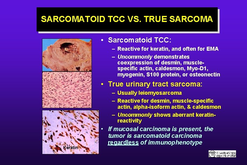 SARCOMATOID TCC VS. TRUE SARCOMA • Sarcomatoid TCC: – Reactive for keratin, and often