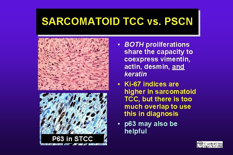 SARCOMATOID TCC vs. PSCN • BOTH proliferations share the capacity to coexpress vimentin, actin,